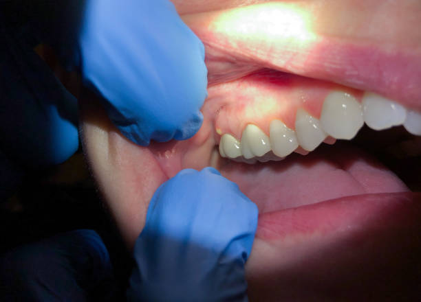 Best Emergency Denture Repair in Taneytown, MD